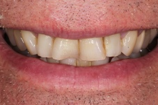 Closeup of Jack before Long Island veneers and porcelain crowns treatment