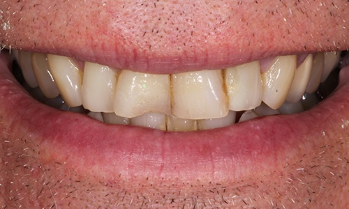 Close-up of smile with chipped teeth
