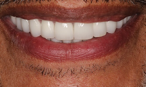 Smile newly improved after treatment in December 2018
