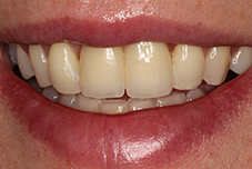 Closeup of Jackie's smile after treatment
