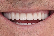 Closeup of George after dental implant dentures