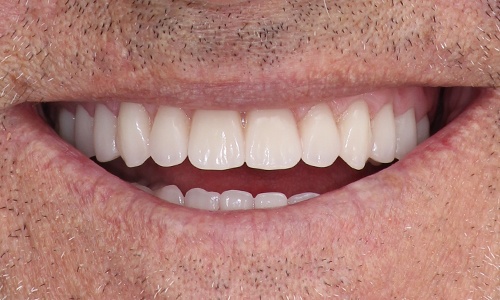 Close-up of February 2021 patient's newly revitalized smile