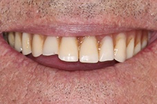 Closeup of George before Long Island dental implant dentures