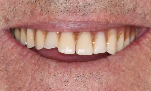 Close-up of February 2021 patient's smile before treatment