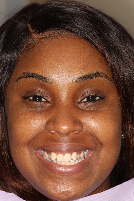 Headshot of Jonelle before treatment