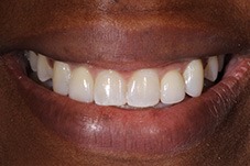 Closeup of Jonelle after Long Island cosmetic dentistry