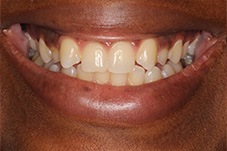 Closeup of Jonelle before Long Island cosmetic dentistry