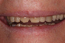 Closeup woman's damaged smile before treatment