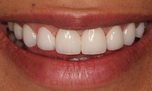 Close-up of Karen's smile after veneers