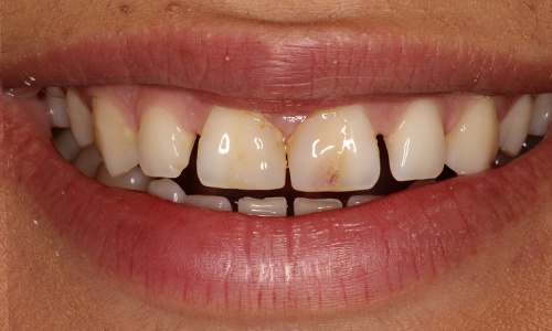 Close-up of Karen's smile before veneers