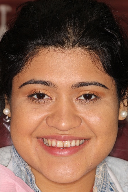 Headshot of Karen before veneers