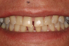 Closeup of teeth before treatment