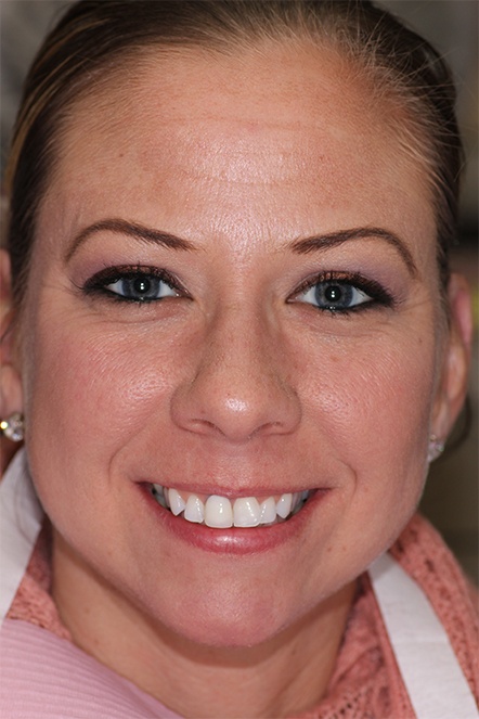 January 2021 patient with tooth misalignment