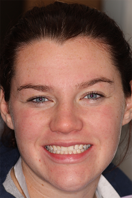 January 2022 patient showing teeth before treatment