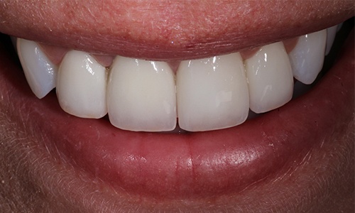 Close-up of teeth that look properly positioned after dental crowns