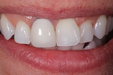 Closeup of Laurynn before Long Island veneers dental treatment