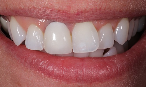Close-up of slightly overlapping teeth