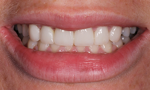 Close-up of brighter teeth that are better aligned