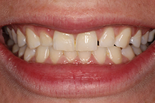 Closeup of Jess before Long Island veneers treatment