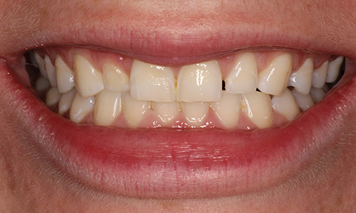 Close-up of yellowed teeth pointing inward