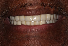Closeup of Glenn's smile after treatment