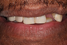 Closeup of Glenn's smile before treatment