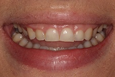 Gummy smile before gum recontouring