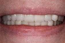 Closeup of Angela after dental implants, porcelain crowns and veneers