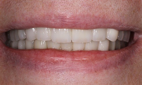Close-up of teeth replaced with dental implants