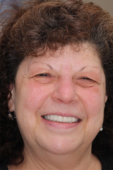 July 2021 dental patient after having teeth replaced