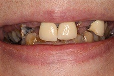 Closeup of Angela before Long Island dental implants, porcelain crowns and veneers