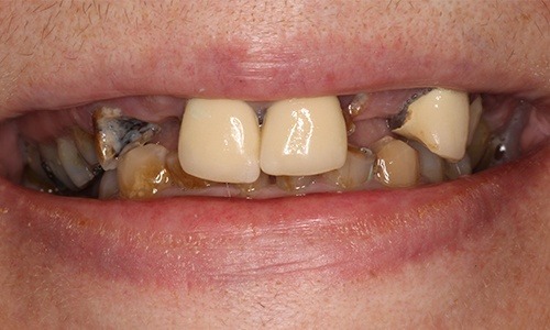 Close-up of smile with extensive tooth loss