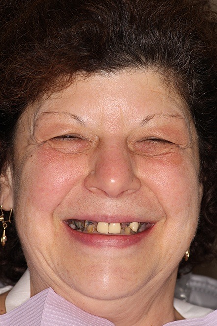 July 2021 dental patient missing multiple teeth