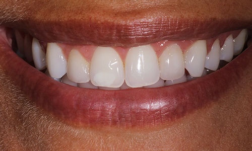 Close-up of smile with teeth that look closer together