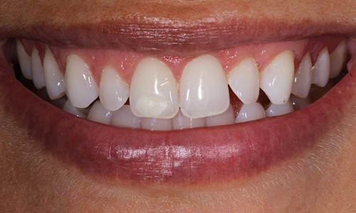 Close-up of smile with noticeable empty space