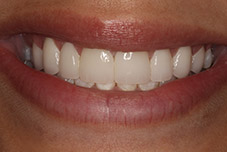 Closeup of Rebecca's smile after treatment