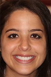 Rebecca's smile after treatment