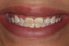 Closeup of Rebecca's smile before treatment