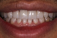 Closeup of patient after porcelain veneers