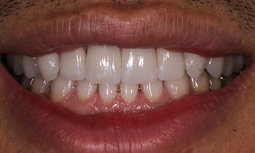 Close-up of June 2021 patient's smile after receiving veneers
