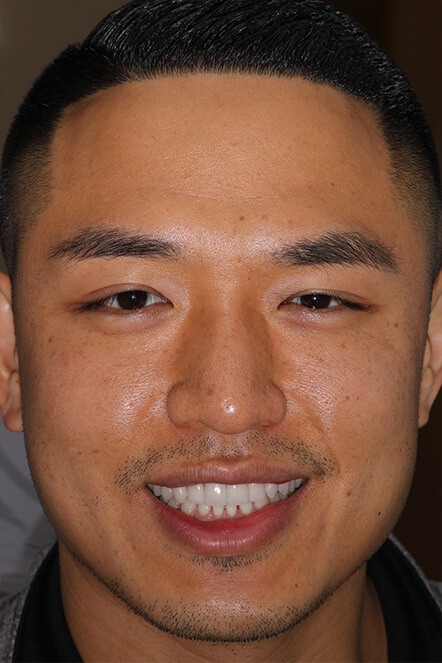 Headshot of June 2021 patient after receiving veneers