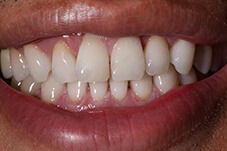 Closeup of patient before Long Island porcelain veneers