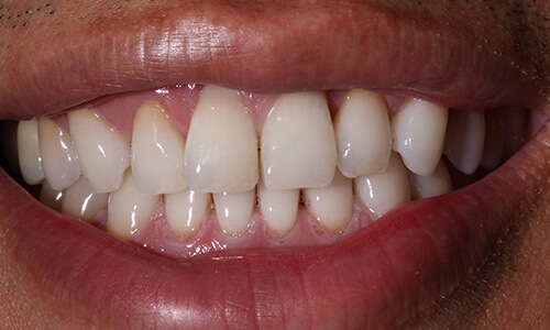 Close-up of June 2021 patient's smile before treatment