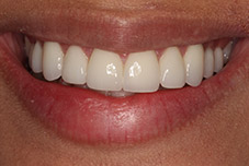 Closeup of Ingrid's teeth after treatment