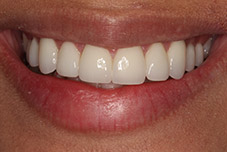Closeup of Ingrid's teeth after treatment