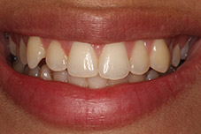 Closeup of Ingrid's teeth before treatment
