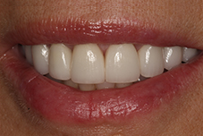 Closeup of Halina's smile after treatment