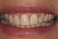 Closeup of Halina's smile before treatment