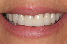 Closeup of Lisa's smile from front after
