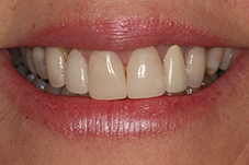 Closeup of Lisa's smile from front before